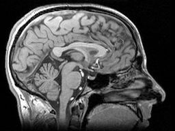The largest volume reached by the brain might be smaller in men with the HD mutation  